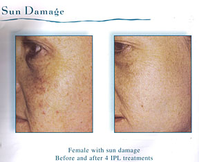 Chicago Laser Wrinkle Reduction